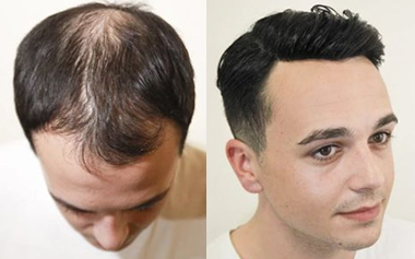 Why do you pay more attention to high-quality men's hair toupee?