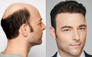 Human Hair Toupee For Men: The Perfect Choice For Everyone