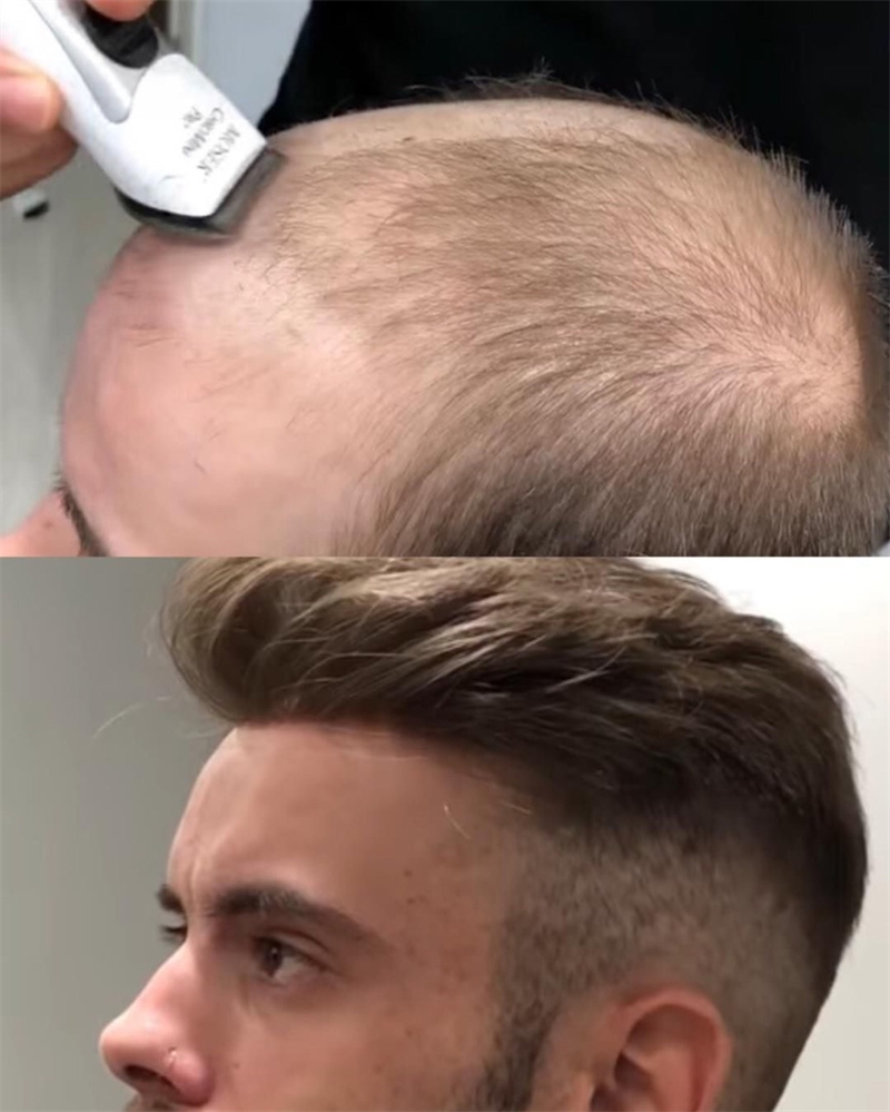 cause of men hair loss