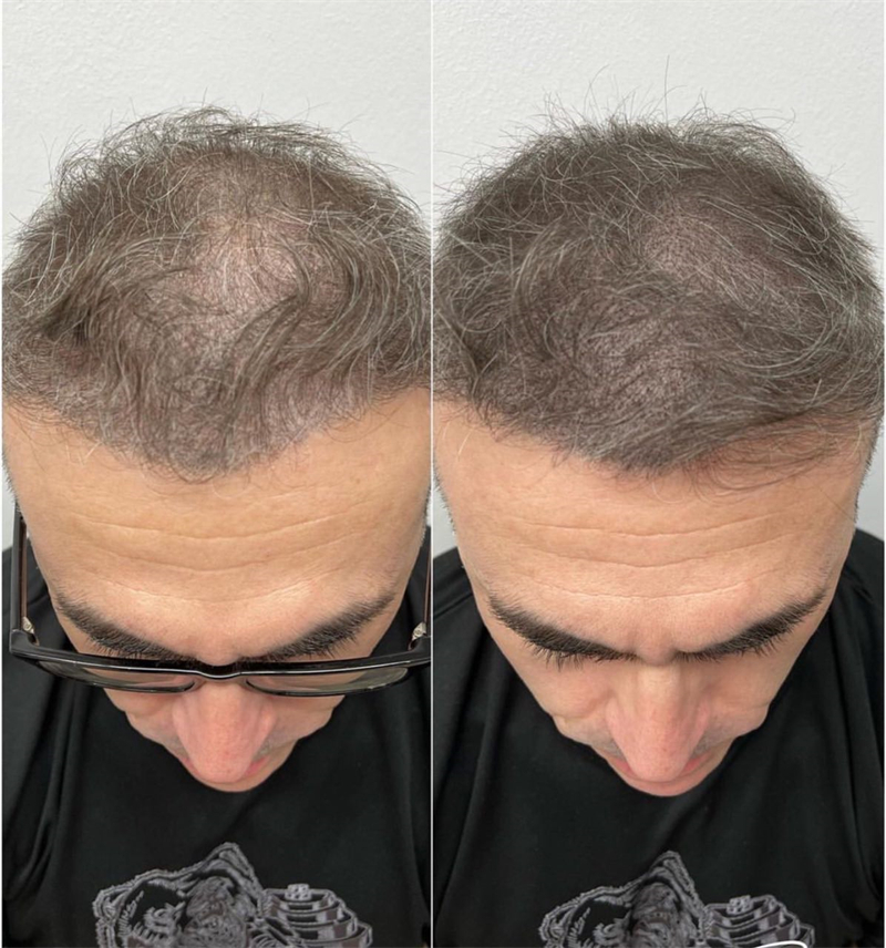 mens hair loss toupee hair